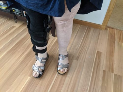 How I finally found sandals that fit my Kafos & disability